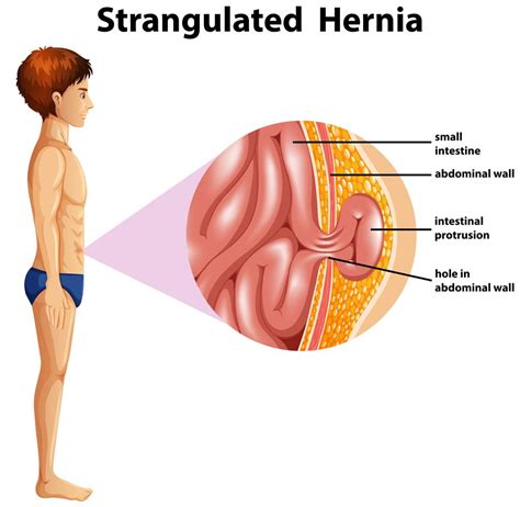 A Human Anatomy Strangulated Hernia 300805 Vector Art At Vecteezy