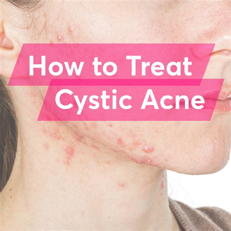 What Is The Best Treatment For Cystic Acne Mdacne