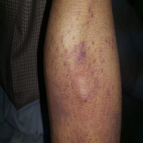 Figure1 Violet Brownish Cutaneous Ecchymosis And Purpura On The Left