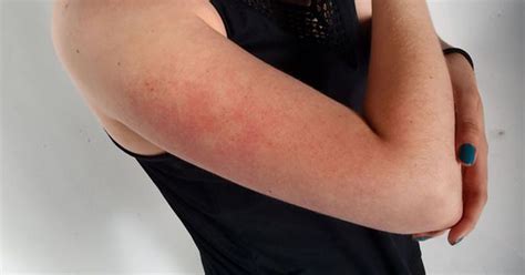 Why Red Dots Appear On Your Arms And How To Get Rid Of Them