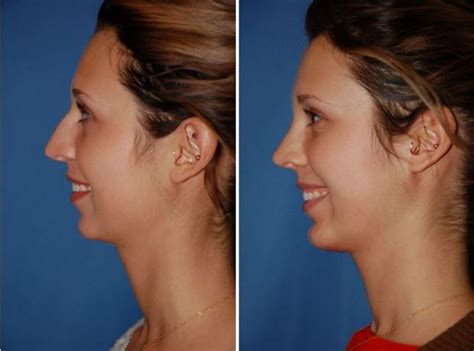 Chin Implant Before And After Stassi