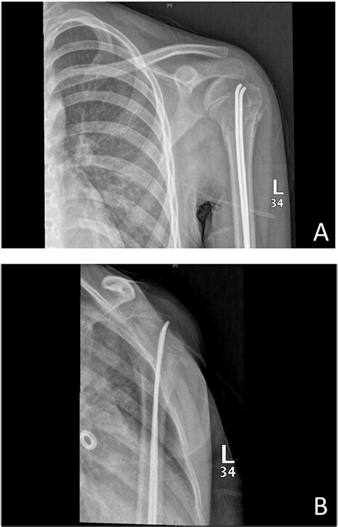 A Ap And B Lateral Shoulder X Rays Couple Of Months Post Operatively