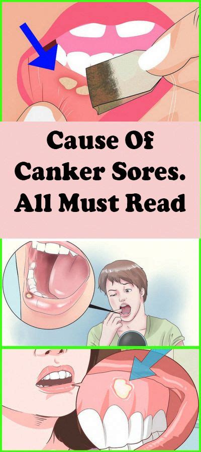 Cause Of Canker Sores All Must Read Howtotakecareoforalhealth