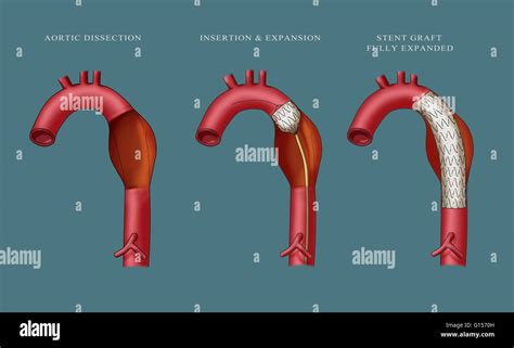 Illustration Depicting Insertion Of An Aortic Aneurysm Stent Far Left