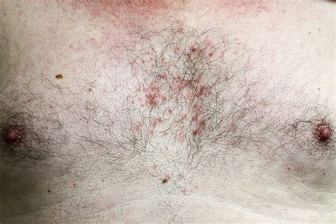 Folliculitis Of The Chest Stock Image C0238917 Science Photo Library