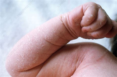 Babys Flaking Skin Stock Image C0129303 Science Photo Library