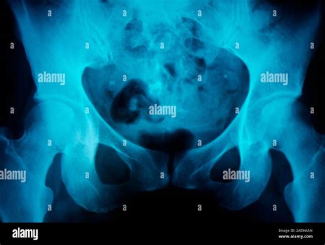 Dermoid Cyst With Tooth X Ray Of The Pelvis Of A 36 Year Old Woman