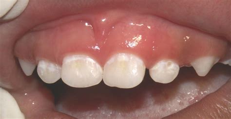 Teeth Care In Children Child Health
