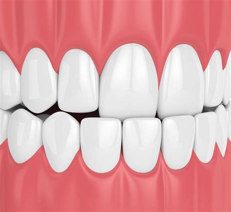 How To Correct An Underbite Fairfield Dental Arts