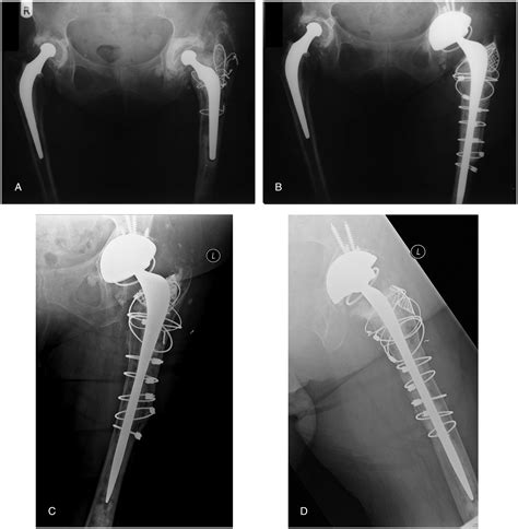 Extended Trochanteric Osteotomy Followed By Cemented Impaction