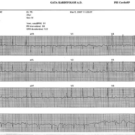 Patients Baseline Electrogram Sinus Rhythm At 91 Beats Per Minute Pr