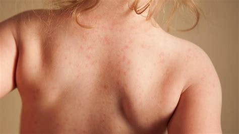 Heat Rash Dermatitis Eczema Most Common Rashes In Children Kidspot