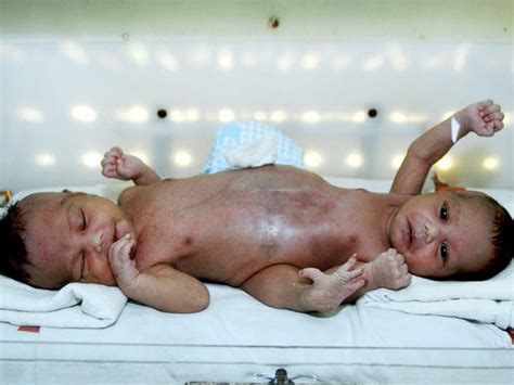 Conjoined Twins Conjoined Twins Warning Graphic Images Pictures