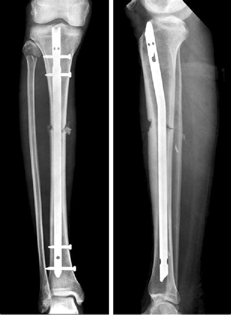 Postoperative Radiographs Of This Proximal Tibial Shaft Fracture Show