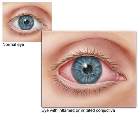 Allergic Conjunctivitis Types Causes And Treatment Eyes Advisor