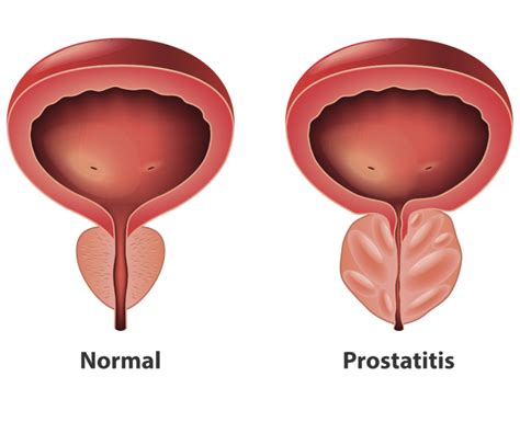 Prostatitis Prostate Infection Causes Symptoms And Treatment Premier Mens Medical