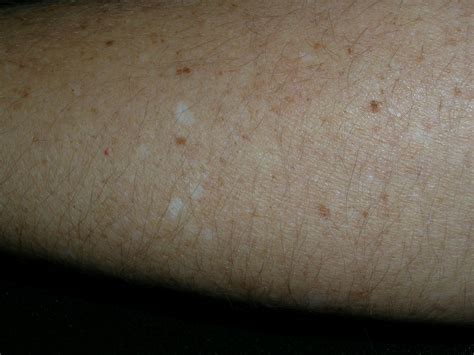Skin Cancer White Spots On Arms