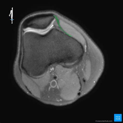 How To Read The Normal Knee Mri Kenhub