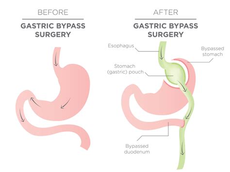 Can You Have Gastric Bypass Twice Learn More With Bari Life Blogs