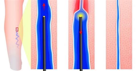 Endovenous Laser Therapy Ucosmetic