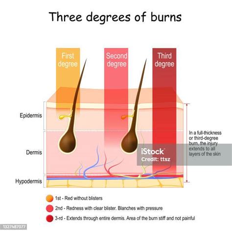Skin Burn Three Degrees Of Burns Stock Illustration Download Image