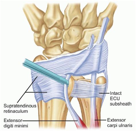 In refractory cases ecu subsheath reconstruction may be considered. Surgical Treatment for Extensor Carpi Ulnaris Subluxation ...