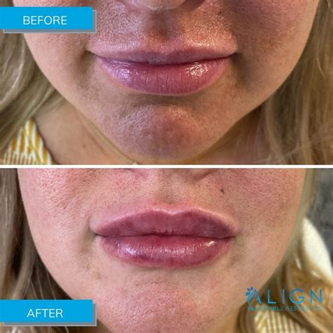 Kristalyn R Before And After Lip Injections Align Injectable Aesthetics
