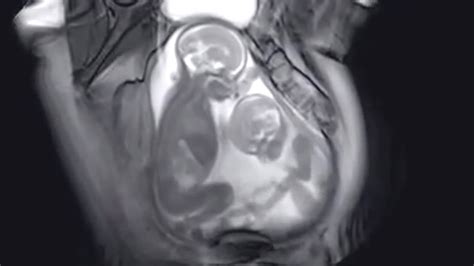 Watch Pregnancy Mris Reveal How Babies Really Move In Utero What To