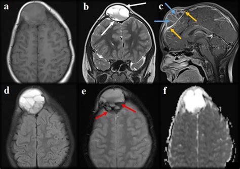 Brain Mr A Axial T1 Weighted Image B Coronal T2 Weighted Image