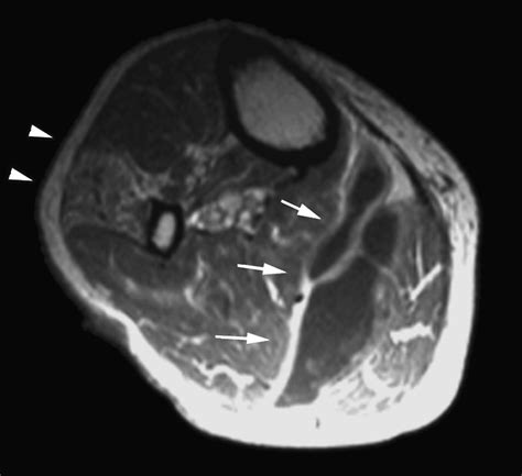 Non Traumatic Peroneal Nerve Palsy Mri Findings Clinical Radiology