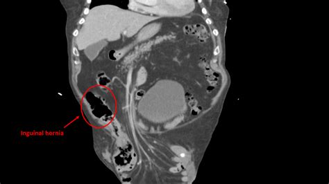 Inguinal Hernia Ct Wikidoc