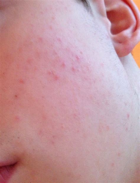 Was sind das für rote Punkte auf meiner Wange?( Bild ) (Gesundheit ...