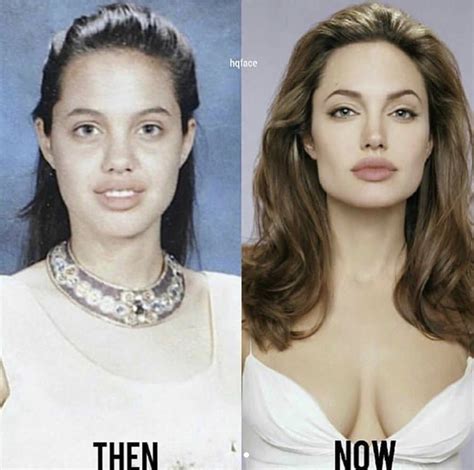 A small but strong muscle that runs vertically from the internal upper lip to the hidden portion of the front of the nasal septum, appropriately called the nose depressor, can be released from the nasal attachments. Welcome to | Angelina jolie plastic surgery, Celebrity ...