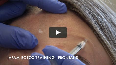 Botox Training Injecting Frontalis On Vimeo