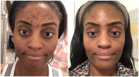 Tretinoin Before And After For 5 Skin Problems Best For Acne Find Out