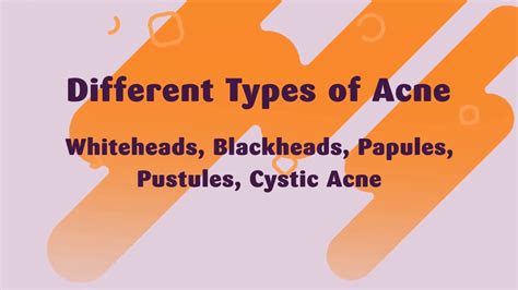 Different Types Of Acne And Treatments Youtube