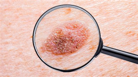 Types Of Skin Lesions The Benign And Malignant