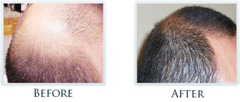 Hair Restoration Portland - Hair Growth Portland Oregon - Hair Rejuvenation System Portland OR ...