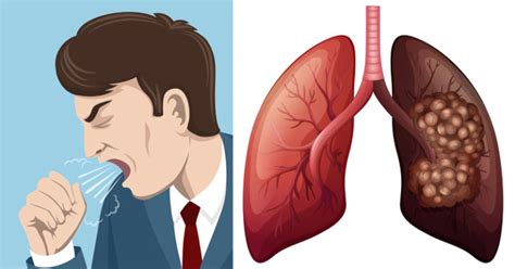 But lung cancer also occurs in people who never smoked and in those who never had prolonged exposure to. 8 Early Warning Signs of Lung Cancer You Should Know ...