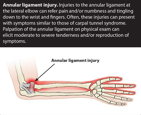 Elbow Pain Ulnar Collateral Ligament Sprain