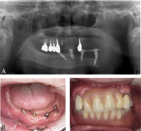 A Panoramic X Ray Shows 4 Dental Implants Placed In The Native And