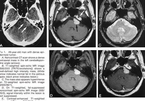 Figure 1 From Unusual Ct And Mr Appearance Of An Epidermoid Tumor Of