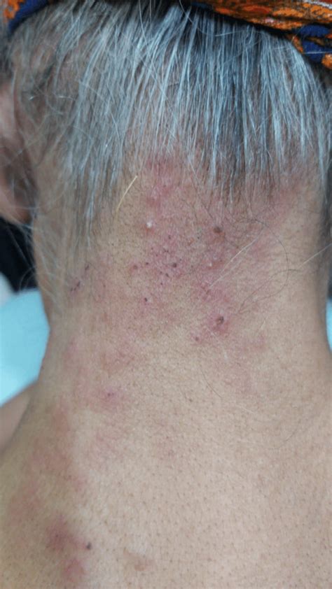 Female Patient With Zosteriform Rash On Her Nape Of The Neck Download