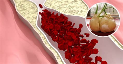 Reverse Heart Disease Before It’s Too Late With These Powerful Natural