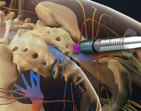 Caudal Epidural Steroid Injection Treatments Twin Cities Pain Clinic