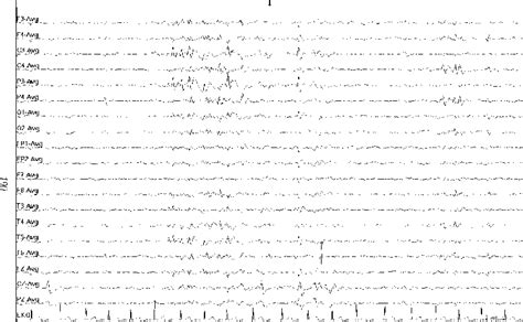 Specific Epileptic Syndromes Conduction Studies