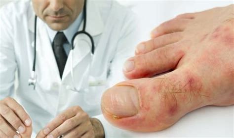 Coronavirus Symptoms Update Covid Toes Are Chilblain Like Lesions