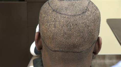 Hair Transplant Surgery Using Fue Method Donor Scar Result By Dr Diep