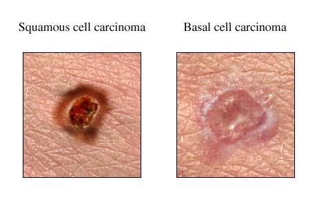 Squamous Cell Carcinoma Skin Cancer Dorothee Padraig South West Skin Health Care