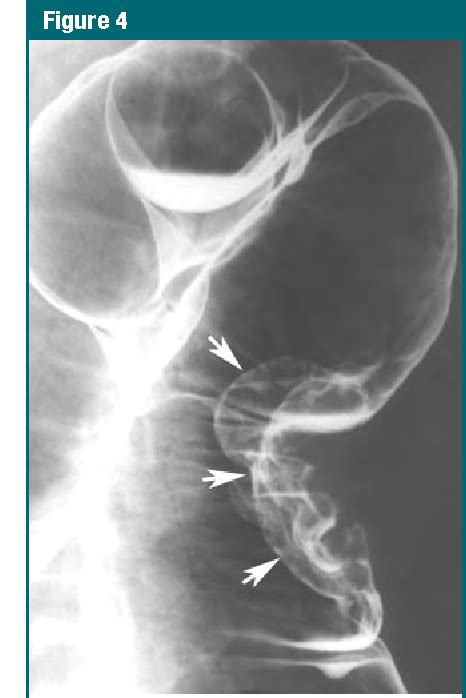 Figure 3 From Colorectal Cancer Screening Double Contrast Barium